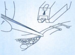 Disposable Surgical Staplers use2.jpg