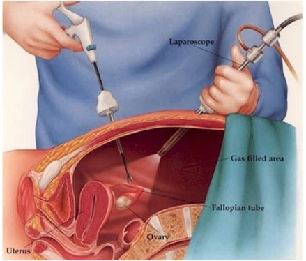 Instrumentos laparoscópicos utilizados en cirugía bariátrica